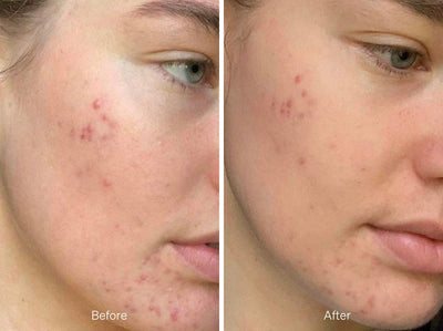before and after photo of young female using About time we met products to deal with acne