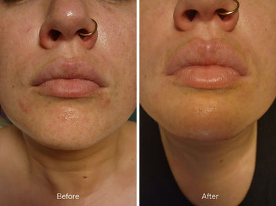 before and after photo of young female using About time we met products for brighter and clearer skin