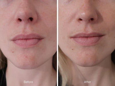 before and after photo of female with improved skin from About time we met's radiance serum